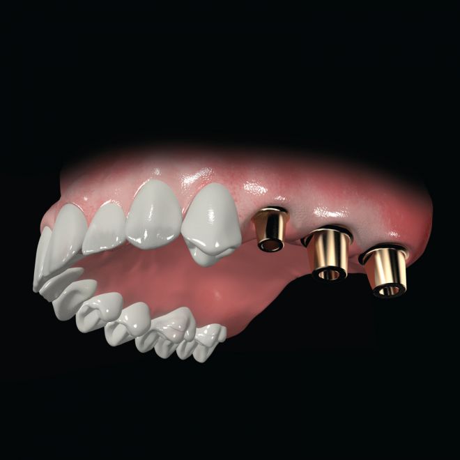 Fixed Prostheses Megagen